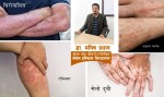 छालाको समस्या र सही उपचार 